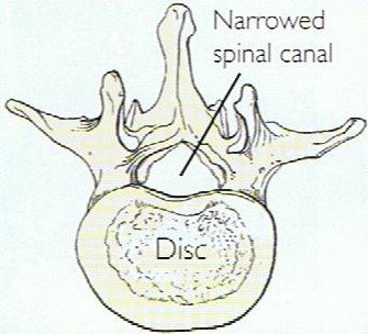 Estenose da coluna lombar (4)