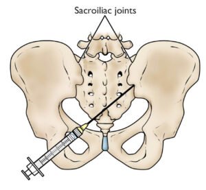 Infiltração da articulação sacroilíaca