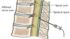 Infiltrações epidurais e foraminais