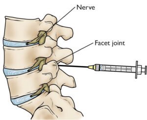 Infiltrações facetarias radiofrequência