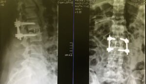 Lateral Lumbar Interbody Fusion2