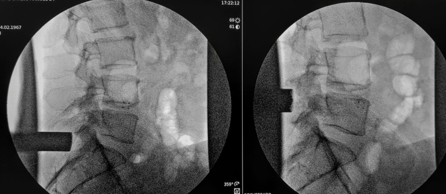 cirurgia mini invasiva de coluna