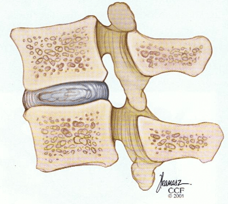 hernia discal cervical (1)