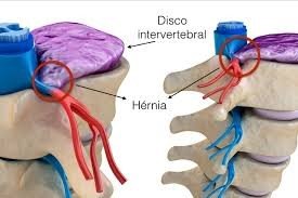 hernia discal cervical (2)