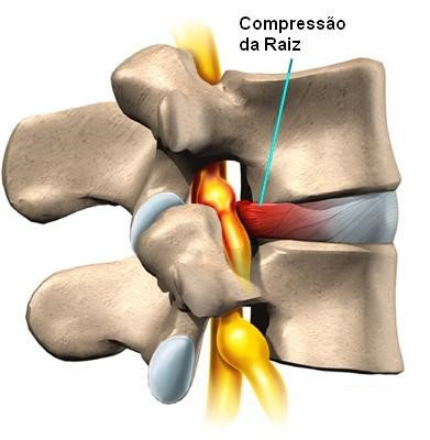 hernia-discal-cervical (3)