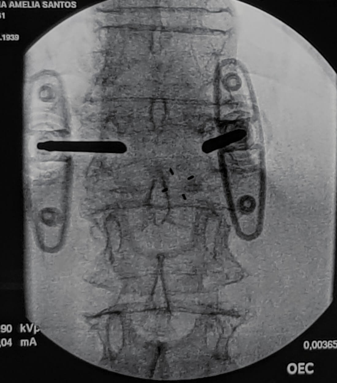 Fratura osteoporóticas