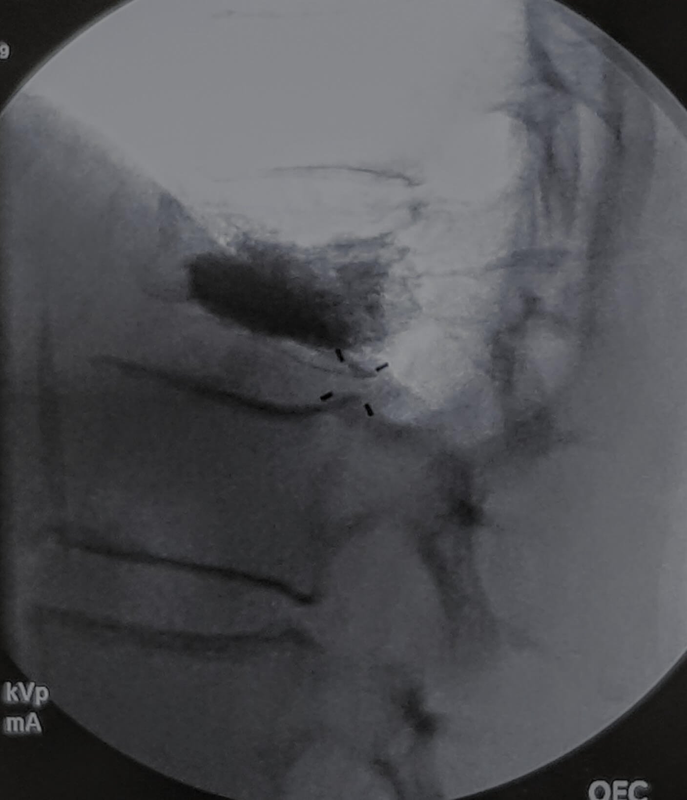 Fratura osteoporóticas