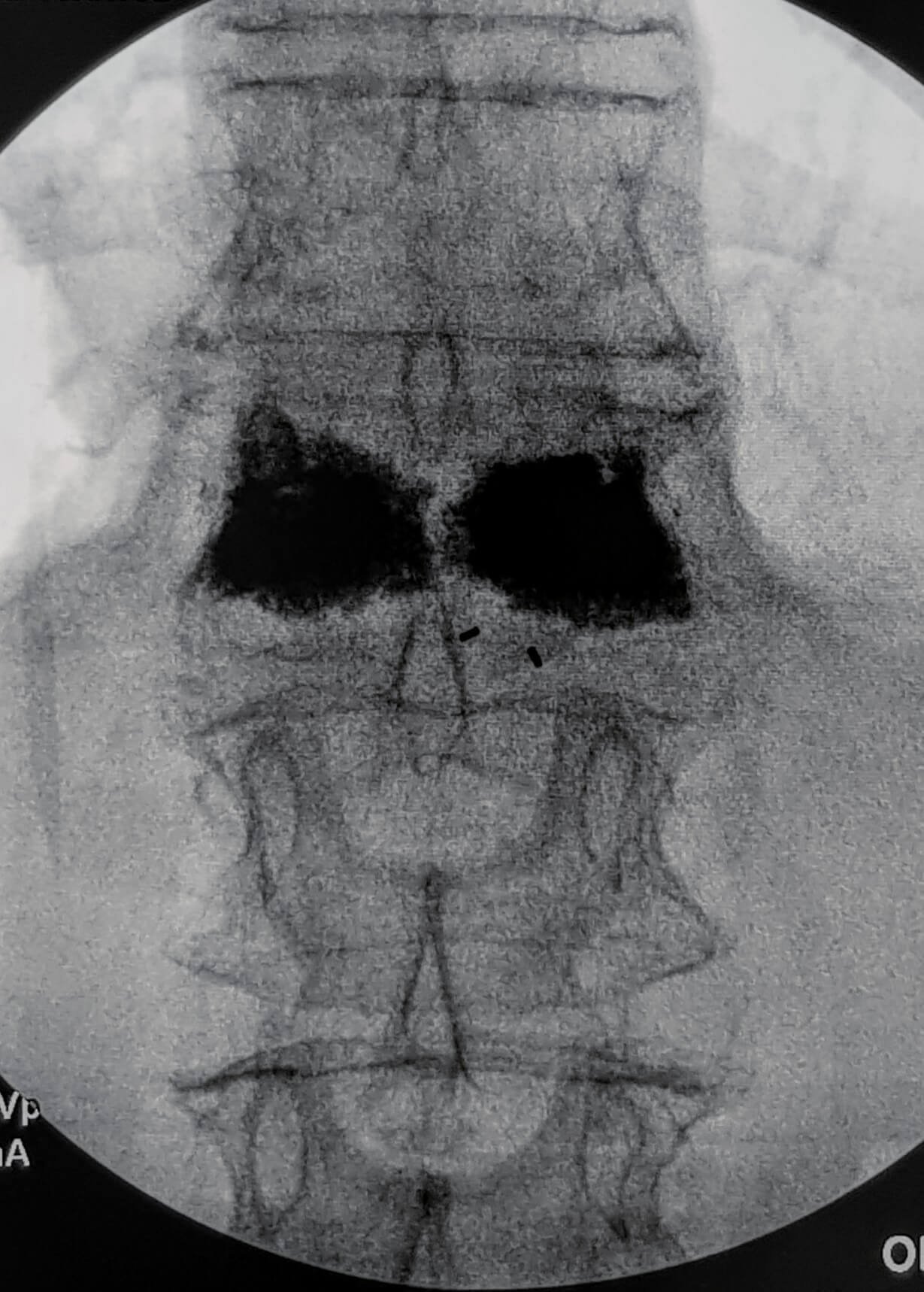 Fratura osteoporóticas2