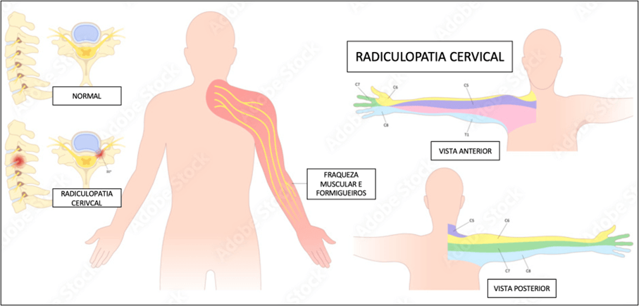 hernia discal cervical medicos (2)